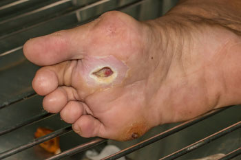 diabetic foot